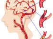 Understanding the Rising Risk of Hemorrhagic Strokes