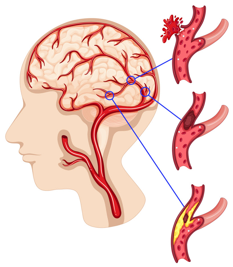 Understanding the Rising Risk of Hemorrhagic Strokes Understanding the Rising Risk of Hemorrhagic Strokes